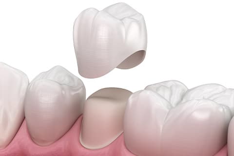 Corona su denti naturali