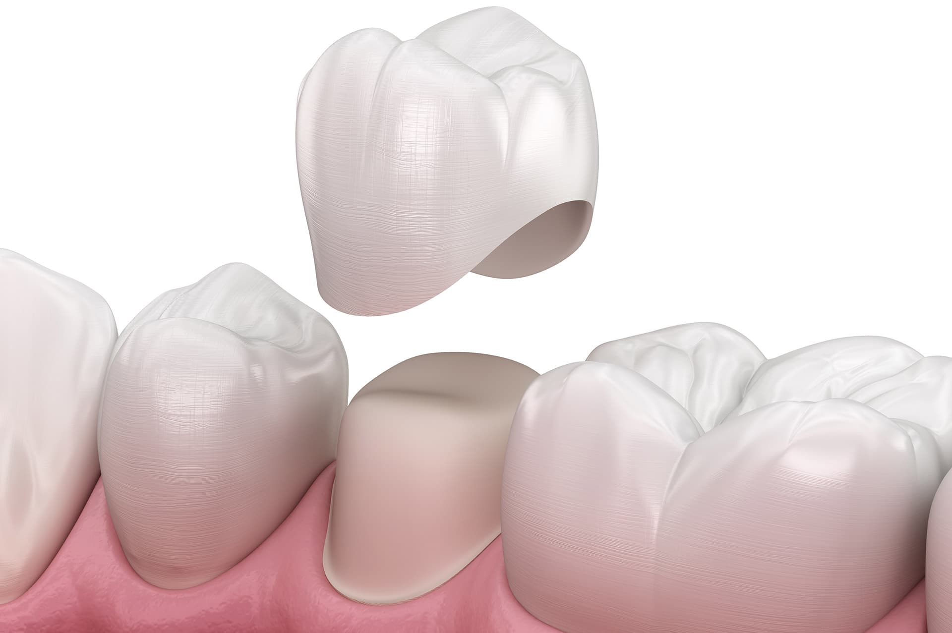 Corona su denti naturali