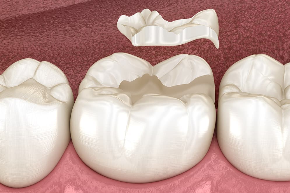 Otturazioni in ceramica e composito