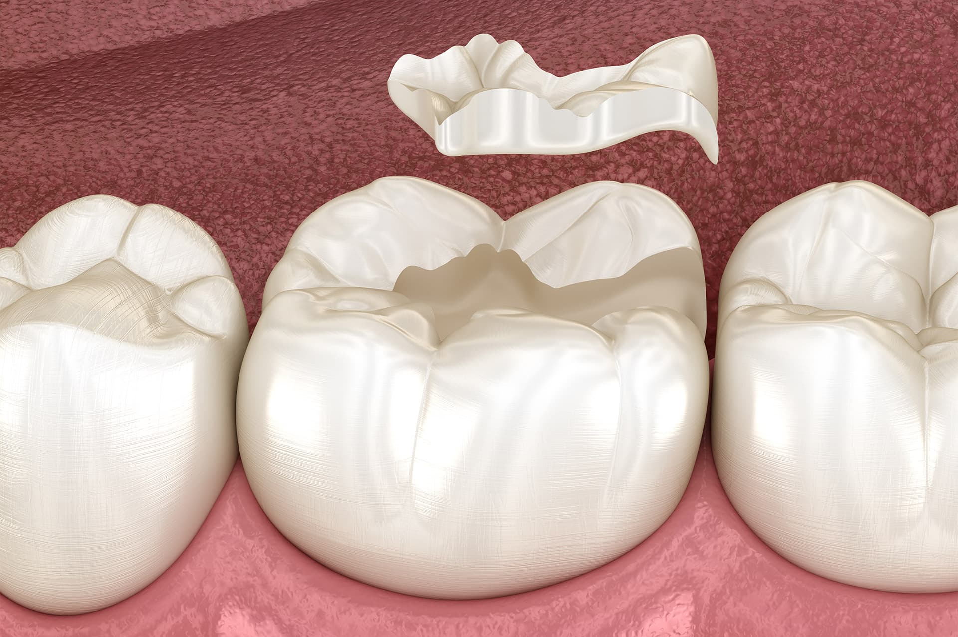 Otturazioni in ceramica e composito